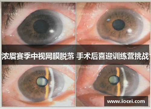 浓眉赛季中视网膜脱落 手术后喜迎训练营挑战